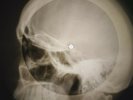 Rolling Stones - Stoned X-RAY OF THE USSR X-RAY BONE RECORDING SKULL