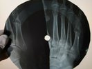 DAVIE JONES KING LISA JANE X-Ray USSR Record Roentgen Bones Ribs Music Vinyl