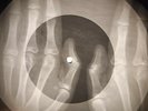 Bobby Rydell - Wild One X-RAY OF USSR X-RAY BONE RECORDING