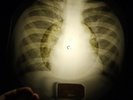 Beatles - Ticket To Ride X-RAY OF THE USSR X-RAY BONE RECORDING