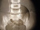 Beatles - Maxwell's Silver Hammer X-RAY OF THE USSR X-RAY BONE RECORDING