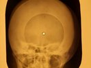 David Bowie - Rosalyn X-RAY OF THE USSR X-RAY BONE RECORDING