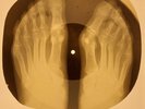 X-RAY FEET USSR  ROENTGEN BONES RECORD ORIGINAL OLD RIBS 615