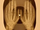 X-RAY USSR  ROENTGEN BONES RECORD ORIGINAL OLD RIBS 633