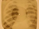 78 rpm X-RAY USSR ROENTGEN BONES RECORD ORIGINAL OLD RIBS 611