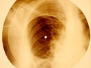 X-RAY USSR ROENTGEN BONES RECORD ORIGINAL OLD RIBS 773