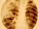 X-RAY USSR ROENTGEN BONES RECORD ORIGINAL OLD RIBS 855