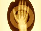 USSR X-RAY HAND ROENTGEN BONES RECORD ORIGINAL OLD RIBS 975