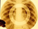 X-RAY USSR ROENTGEN BONES RECORD ORIGINAL OLD RIBS 101